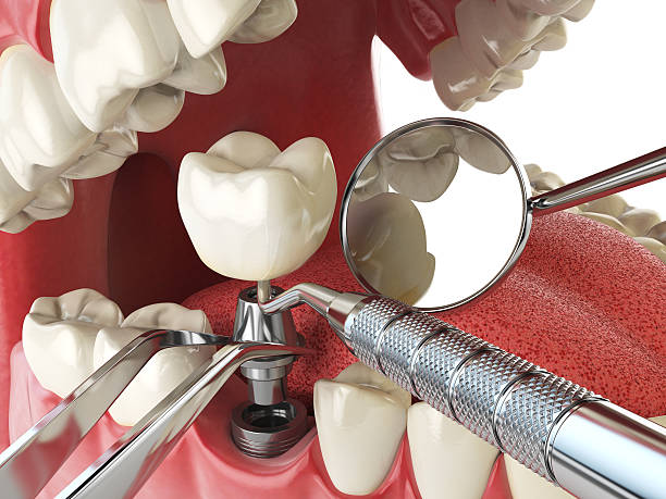 Best Emergency Broken Tooth Repair in Laguna Heights, TX